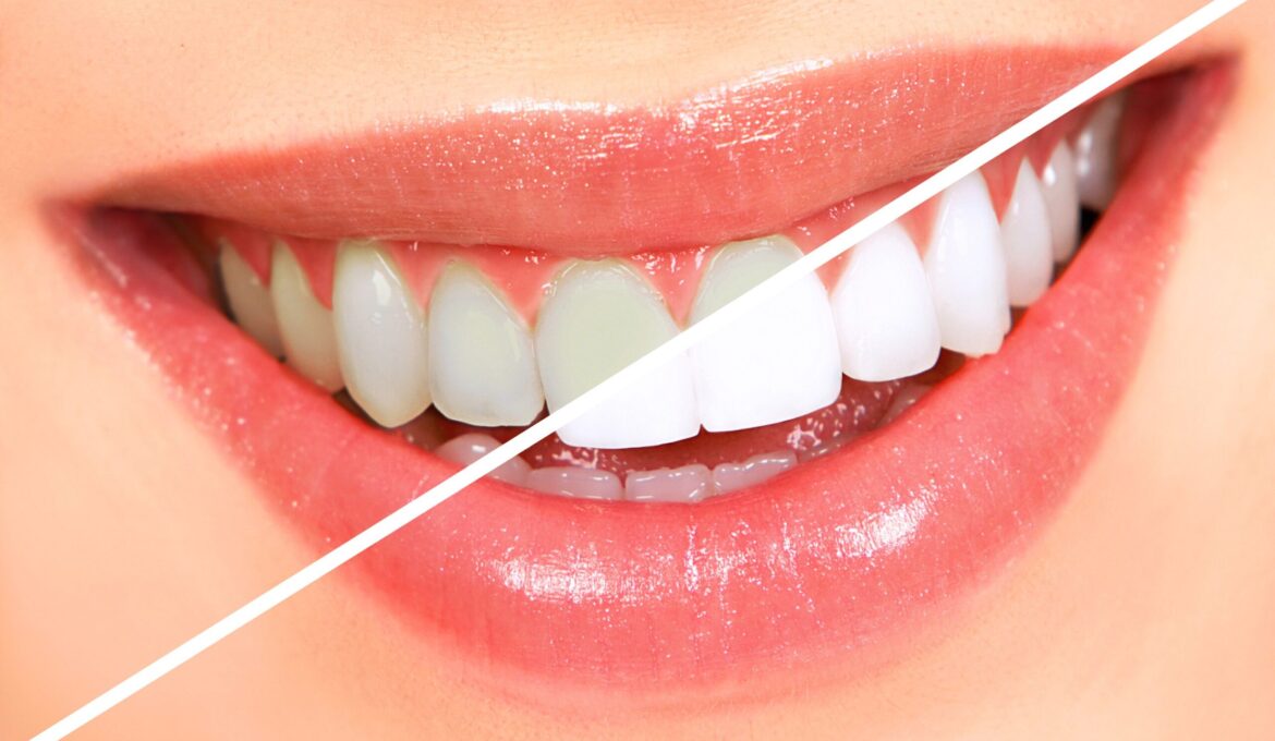 20 - teeth whitening