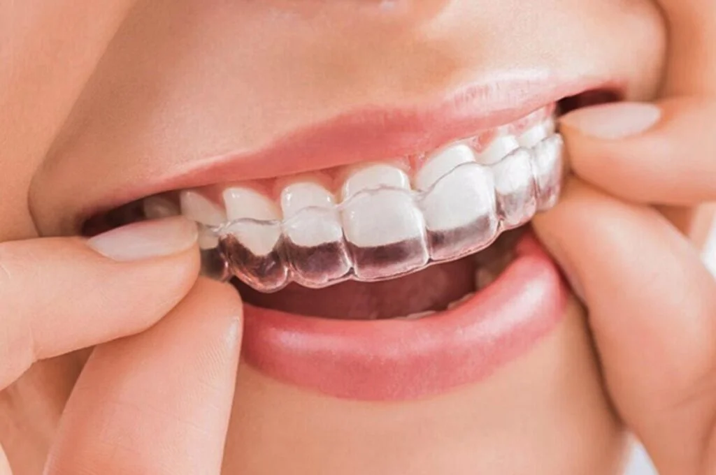BẢNG GIÁ NIỀNG RĂNG TẠI ĐÀ NẴNG CẬP NHẬT MỚI NHẤT THEO TỪNG PHƯƠNG PHÁP ĐIỀU TRỊ