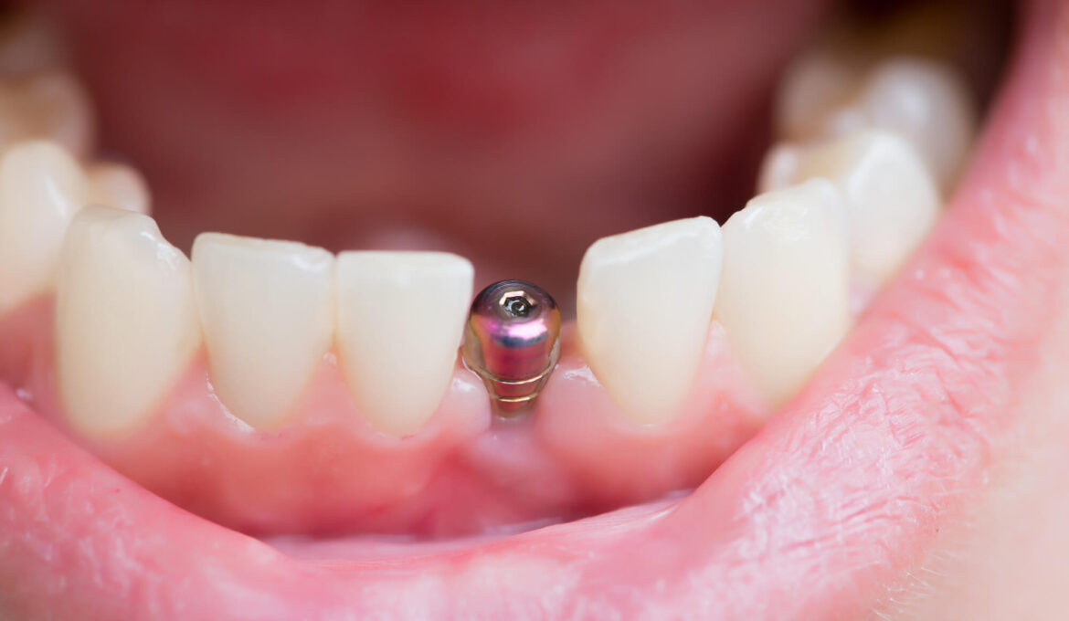 dental-implant-care