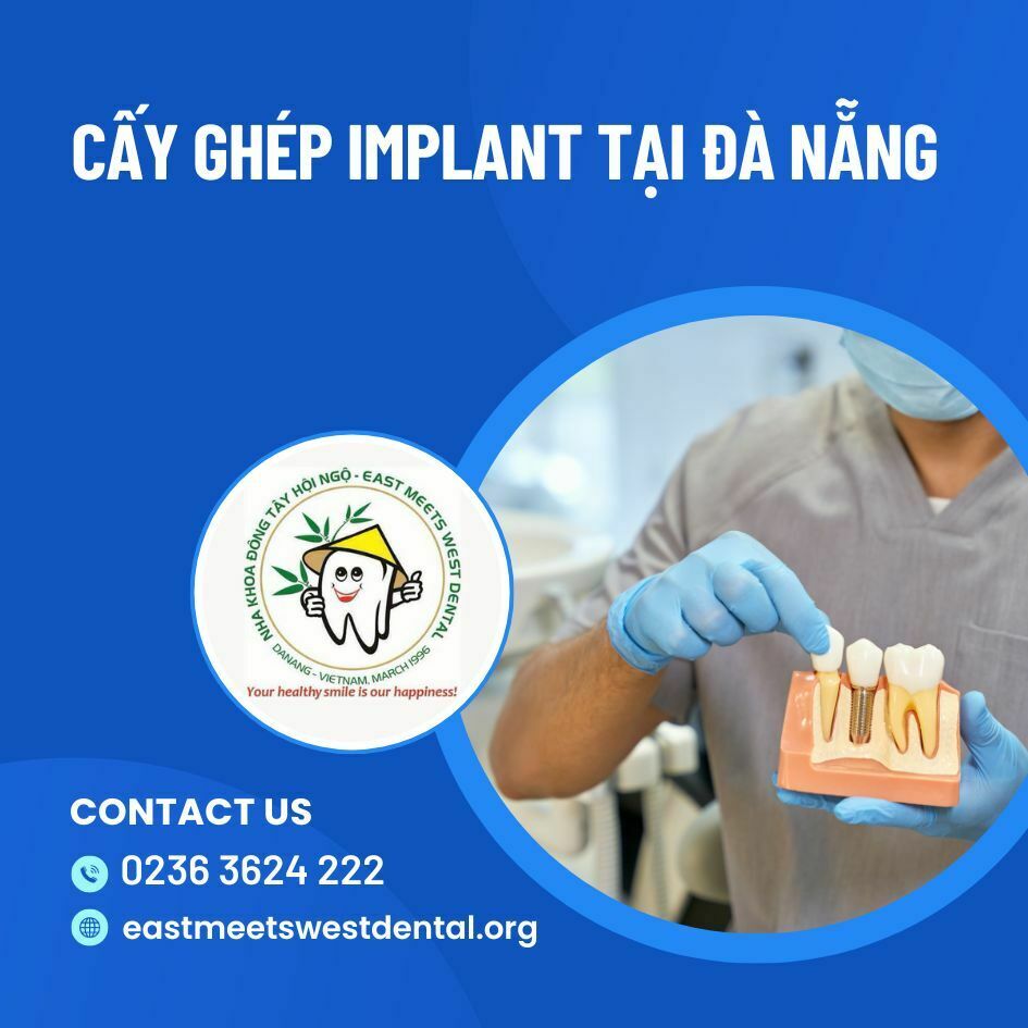 cay-ghep-implant-tai-da-nang-1
