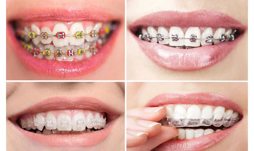 CHI PHÍ NIỀNG RĂNG MỘT HÀM TÙY THUỘC VÀO TÌNH TRẠNG VÀ PHƯƠNG PHÁP ĐIỀU TRỊ