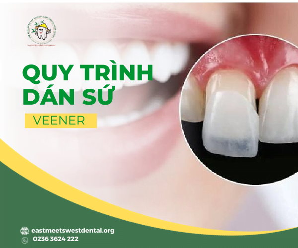 quy-trinh-dan-su-veneer-tai-nha-khoa