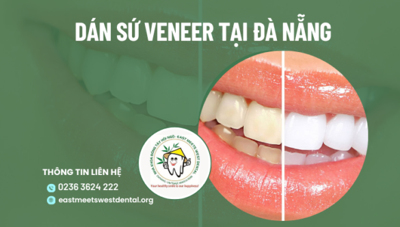 Mách bạn địa chỉ dán sứ Veneer tại Đà Nẵng uy tín