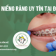 Niềng răng tại Đà Nẵng giá bao nhiêu? Ở đâu uy tín?