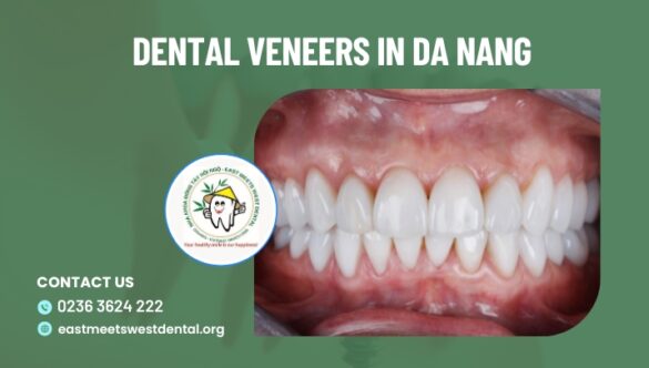 Dental Veneers in Da Nang