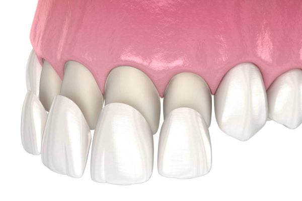 dịch-vu-dan-su-veneers-tai-da-nang