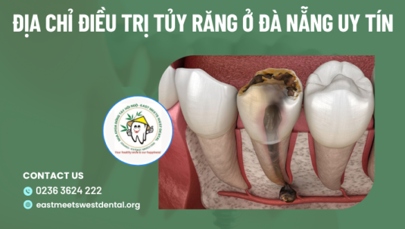 Địa chỉ điều trị tủy răng tại Đà Nẵng uy tín