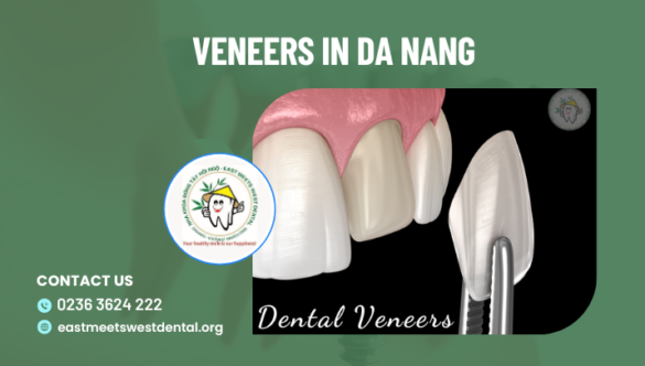 Veneers in Da Nang