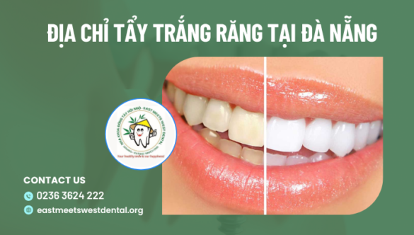 Địa chỉ tẩy trắng răng tại Đà Nẵng uy tín