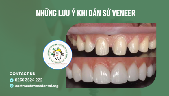 Những Lưu Ý Khi Dán Sứ Veneer bạn cần biết