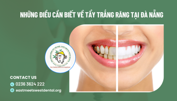 Những điều cần biết về dịch vụ tẩy trắng răng tại Đà Nẵng