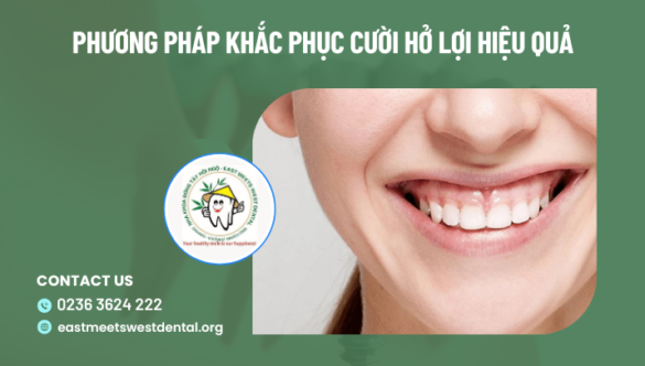 Phương pháp khắc phục cười hở lợi hiệu quả
