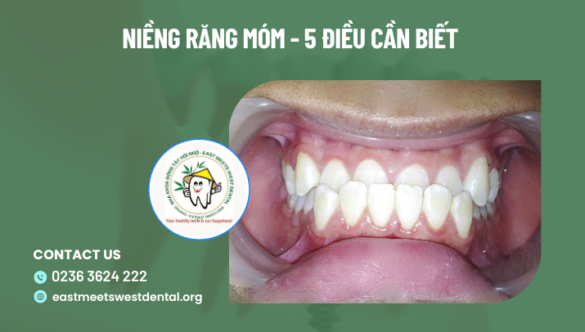 Niềng răng móm tại Đà Nẵng – 5 điều cần biết trước khi thực hiện