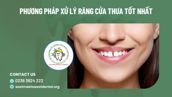 3 phương pháp xử lý thưa răng cửa tốt nhất