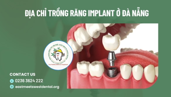 Địa chỉ trồng răng Implant ở Đà Nẵng uy tín – chất lượng