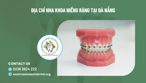 Địa chỉ nha khoa niềng răng tại Đà Nẵng