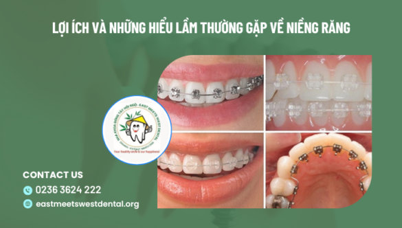 Lợi ích và những hiểu lầm thường gặp về niềng răng