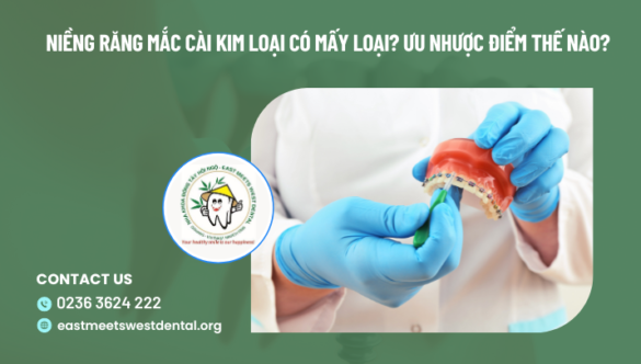 Niềng răng mắc cài kim loại có mấy loại? ưu nhược điểm thế nào?