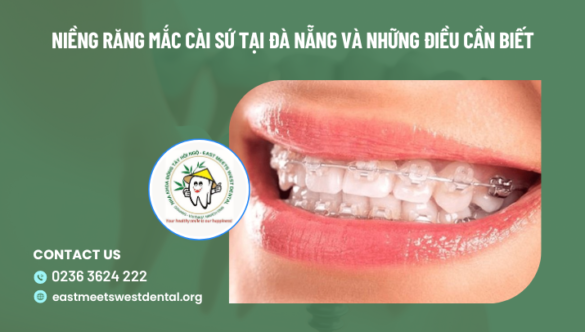 Niềng răng mắc cài sứ tại Đà Nẵng và những điều cần biết