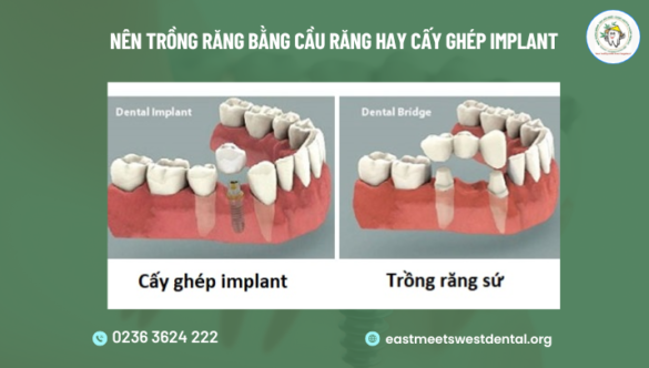 Nên trồng răng bằng cầu răng hay cấy ghép implant