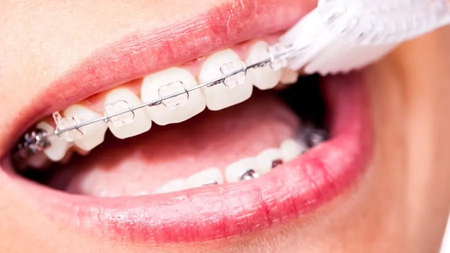 Nha khoa niềng răng mắc cài sứ uy tín Đà Nẵng