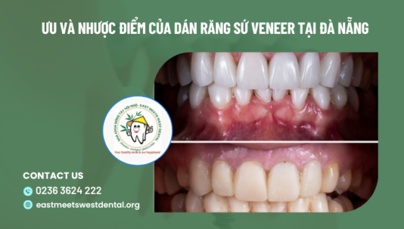 Ưu và nhược điểm của dán răng sứ Veneer tại Đà Nẵng mà bạn nên biết