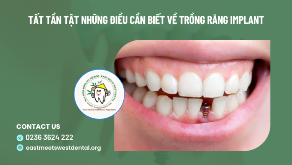 Tất tần tật những điều cần biết về trồng răng implant