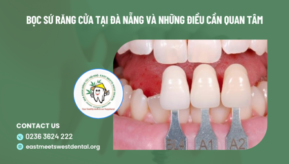 Bọc sứ răng cửa tại Đà Nẵng và những điều cần quan tâm
