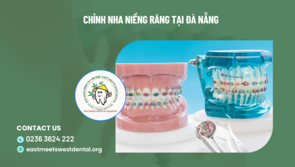 Địa chỉ niềng răng – chỉnh nha tại Đà Nẵng uy tín