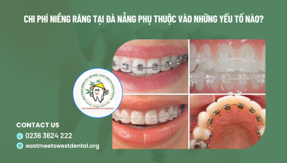 Chi phí niềng răng tại Đà Nẵng phụ thuộc vào những yếu tố nào?