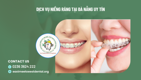 Dịch vụ niềng răng tại Đà Nẵng uy tín