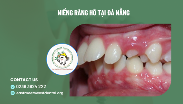 Niềng Răng Hô Tại Đà Nẵng