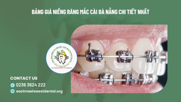 Bảng giá niềng răng mắc cài Đà Nẵng chi tiết nhất