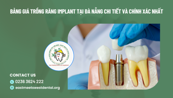 Bảng giá trồng răng implant tại Đà Nẵng chi tiết và chính xác nhất