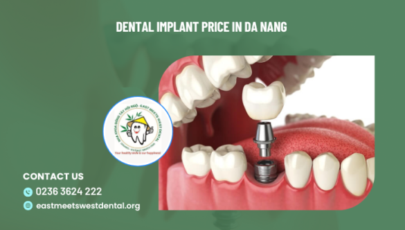 Dental implant price in Da Nang – what factors does it depend on?