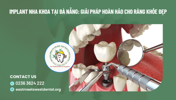 Implant nha khoa tại Đà Nẵng: Giải pháp hoàn hảo cho răng khỏe đẹp