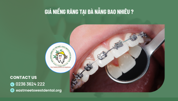 Giá niềng răng tại Đà Nẵng bao nhiêu ?
