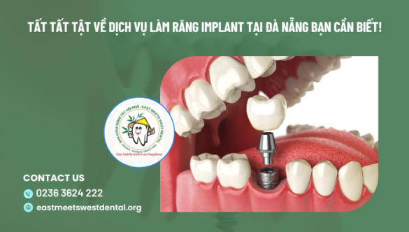 Tất tất tật về dịch vụ làm răng Implant tại Đà Nẵng bạn cần biết!