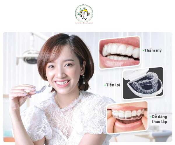 Niềng răng trong suốt là lựa chọn hàng đầu