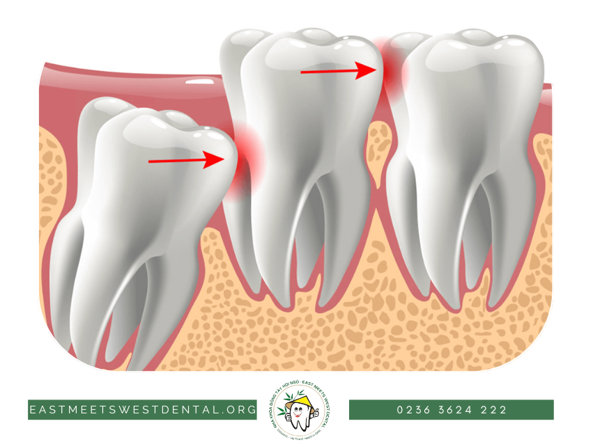 Mọc răng khôn là một nguyên nhân gây đau răng phổ biến ở người trưởng thành