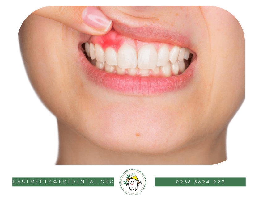 Nhức răng do bệnh về nướu