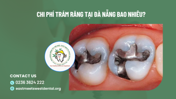 Giá trám răng tại Đà Nẵng bao nhiêu?