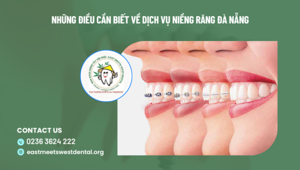 Những điều cần biết về dịch vụ niềng răng Đà Nẵng