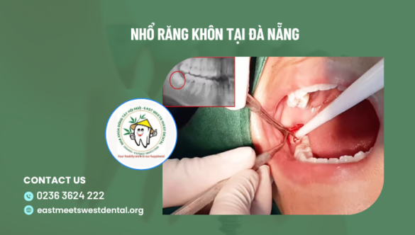Nhổ răng khôn tại Đà Nẵng