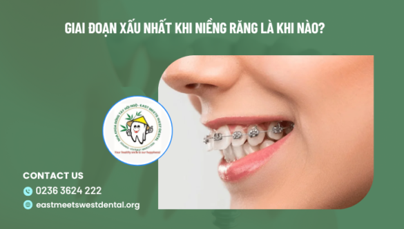 Giai đoạn xấu nhất khi niềng răng là khi nào?