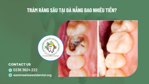 Trám răng sâu tại Đà Nẵng bao nhiêu tiền? Có bị sâu lại không?