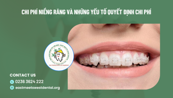 Tổng Chi Phí Niềng Răng Bao Nhiêu Tiền? Bảng giá cập nhật 2024