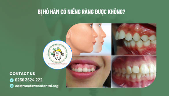 Bị hô hàm có niềng răng được không?