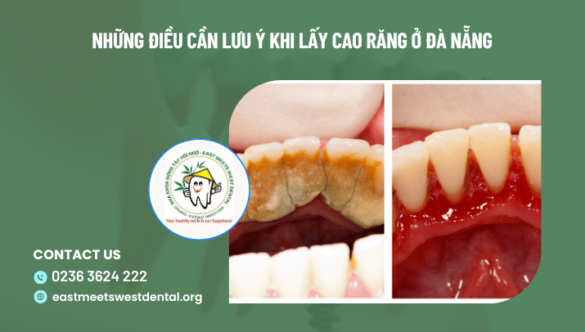 Những điều cần lưu ý khi lấy cao răng ở Đà Nẵng