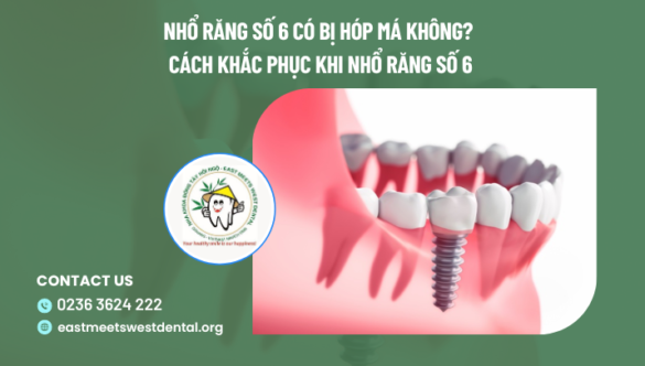 Nhổ răng số 6 có bị hóp má không? Cách khắc phục khi nhổ răng số 6